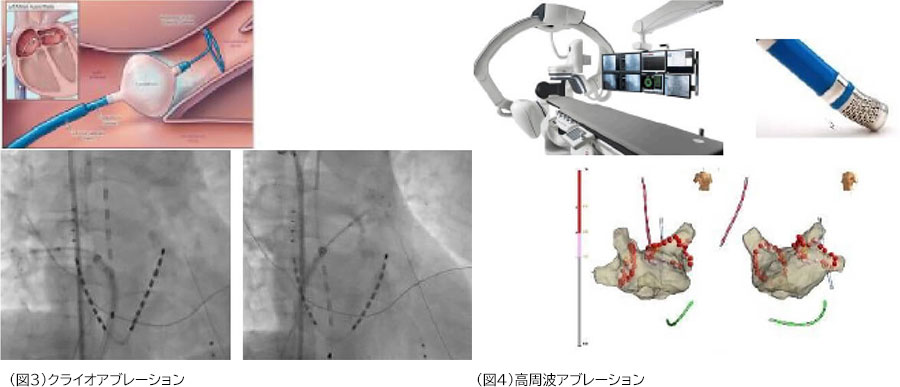 RFAとは何ですか?