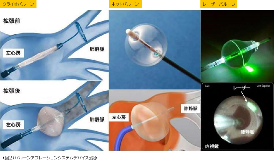 （図2）バルーンアブレーションシステムデバイス治療