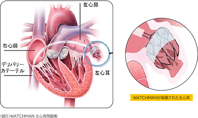 （図5）WATCHMAN 左心耳閉鎖術